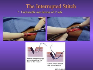 The Interrupted Stitch
• Curl needle into dermis of 1st
side
 