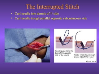 The Interrupted Stitch
• Curl needle into dermis of 1st
side
• Curl needle trough parallel opposite subcutaneous side
 