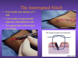 The Interrupted Stitch
• Curl needle into dermis of 1st
side
• Curl needle trough parallel
opposite subcutaneous side
• Tie square knot with at least
two braids
 