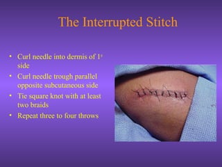 The Interrupted Stitch
• Curl needle into dermis of 1st
side
• Curl needle trough parallel
opposite subcutaneous side
• Tie square knot with at least
two braids
• Repeat three to four throws
 