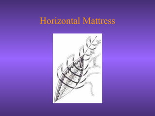 Horizontal Mattress
 