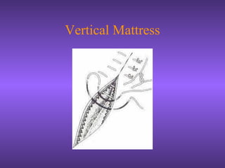 Vertical Mattress
 