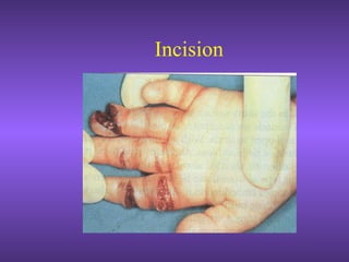 Incision
 