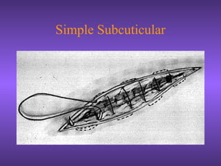 Simple Subcuticular
 
