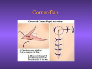 Corner/flap
 