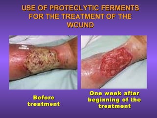 USE OF PROTEOLYTIC FERMENTSUSE OF PROTEOLYTIC FERMENTS
FOR THE TREATMENT OF THEFOR THE TREATMENT OF THE
WOUNDWOUND
BeforeBefore
treatmenttreatment
One week afterOne week after
beginning of thebeginning of the
treatmenttreatment
 