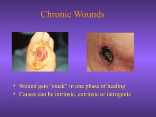 Chronic Wounds
• Wound gets “stuck” in one phase of healing
• Causes can be intrinsic, extrinsic or iatrogenic
 