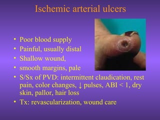 Ischemic arterial ulcers
• Poor blood supply
• Painful, usually distal
• Shallow wound,
• smooth margins, pale
• S/Sx of PVD: intermittent claudication, rest
pain, color changes, ↓ pulses, ABI < 1, dry
skin, pallor, hair loss
• Tx: revascularization, wound care
 