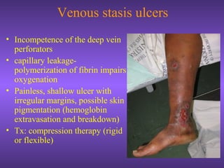 Venous stasis ulcers
• Incompetence of the deep vein
perforators
• capillary leakage-
polymerization of fibrin impairs
oxygenation
• Painless, shallow ulcer with
irregular margins, possible skin
pigmentation (hemoglobin
extravasation and breakdown)
• Tx: compression therapy (rigid
or flexible)
 