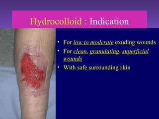 Hydrocolloid : Indication
• For low to moderate exuding wounds
• For clean, granulating, superficial
wounds
• With safe surrounding skin
 