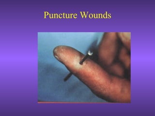 Puncture Wounds
 