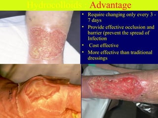 Hydrocolloids : Advantage
• Require changing only every 3 -
7 days
• Provide effective occlusion and
barrier (prevent the spread of
Infection
• Cost effective
• More effective than traditional
dressings
1 week1 week
 
