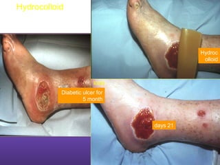 21days
Diabetic ulcer for
5 month
Hydroc
olloid
loids
Hydrocolloid
 