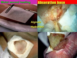 Absorption baseAbsorption base
dressingdressing
AlginateAlginate
HydrofibreHydrofibre
Moist woundMoist wound healinghealingMoist woundMoist wound healinghealing
 