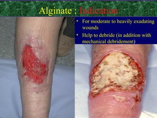 Alginate : Indication
• For moderate to heavily exudating
wounds
• Help to debride (in addition with
mechanical debridement)
 