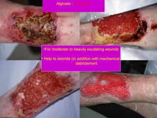 Alginate : Indication
•For moderate to heavily exudating wounds
• Help to debride (in addition with mechanical
debridement
 