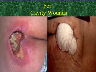 For
Cavity Wounds
 
