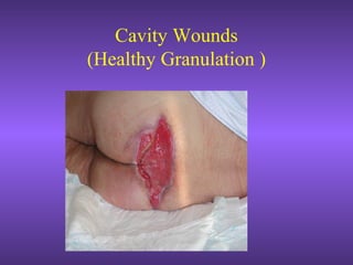Cavity Wounds
(Healthy Granulation )
 