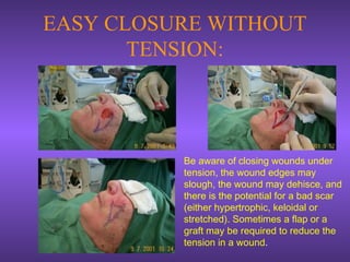 EASY CLOSURE WITHOUT
TENSION:
Be aware of closing wounds under
tension, the wound edges may
slough, the wound may dehisce, and
there is the potential for a bad scar
(either hypertrophic, keloidal or
stretched). Sometimes a flap or a
graft may be required to reduce the
tension in a wound.
 