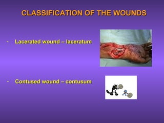 CLASSIFICATION OF THE WOUNDSCLASSIFICATION OF THE WOUNDS
- Lacerated wound – laceratumLacerated wound – laceratum
- Contused wound – contusumContused wound – contusum
 