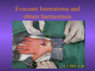 Evacuate haematoma and
obtain haemostasis
 