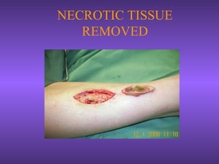 NECROTIC TISSUE
REMOVED
 