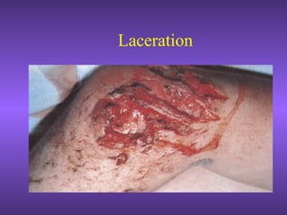 Laceration
 