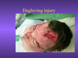 Degloving injury
 