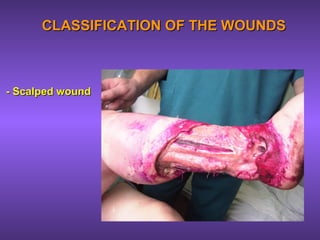 CLASSIFICATION OF THE WOUNDSCLASSIFICATION OF THE WOUNDS
- Scalped wound- Scalped wound
 