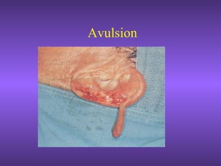 Avulsion
 