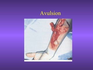 Avulsion
 