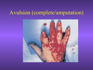 Avulsion (complete/amputation)
 
