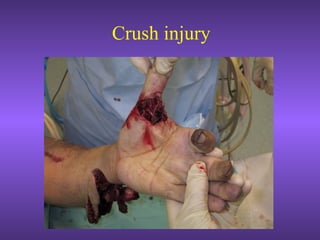 Crush injury
 