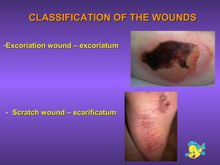 CLASSIFICATION OF THE WOUNDSCLASSIFICATION OF THE WOUNDS
-Excoriation wound – excoriatumExcoriation wound – excoriatum
- Scratch wound – scarificatum- Scratch wound – scarificatum
 