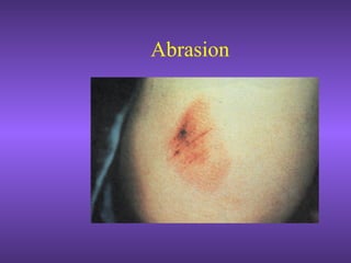 Abrasion
 