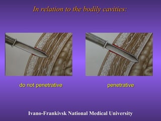In relation to the bodily cavities:In relation to the bodily cavities:
Ivano-Frankivsk National Medical UniversityIvano-Frankivsk National Medical University
penetrativepenetrativedo not penetrativedo not penetrative
 