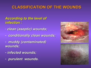 CLASSIFICATION OF THE WOUNDSCLASSIFICATION OF THE WOUNDS
According to the level ofAccording to the level of
infection :infection :
- clean (aseptic) wounds;clean (aseptic) wounds;
- conditionally clean wounds;conditionally clean wounds;
- muddy (contaminated)muddy (contaminated)
wounds;wounds;
- infected wounds;infected wounds;
- purulent wounds.purulent wounds.
 