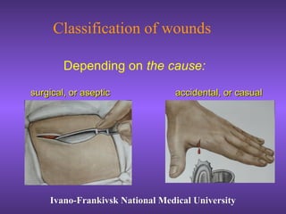 Classification of wounds
Ivano-Frankivsk National Medical UniversityIvano-Frankivsk National Medical University
Depending on the cause:
surgical, or asepticsurgical, or aseptic accidental, or casualaccidental, or casual
 
