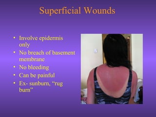 Superficial Wounds
• Involve epidermis
only
• No breach of basement
membrane
• No bleeding
• Can be painful
• Ex- sunburn, “rug
burn”
 