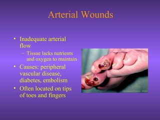 Arterial Wounds
• Inadequate arterial
flow
– Tissue lacks nutrients
and oxygen to maintain
• Causes: peripheral
vascular disease,
diabetes, embolism
• Often located on tips
of toes and fingers
 
