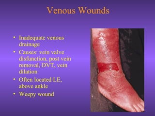 Venous Wounds
• Inadequate venous
drainage
• Causes: vein valve
disfunction, post vein
removal, DVT, vein
dilation
• Often located LE,
above ankle
• Weepy wound
 