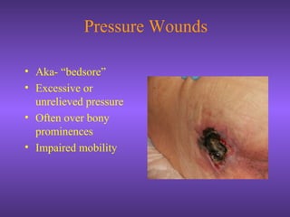 Pressure Wounds
• Aka- “bedsore”
• Excessive or
unrelieved pressure
• Often over bony
prominences
• Impaired mobility
 