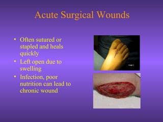 Acute Surgical Wounds
• Often sutured or
stapled and heals
quickly
• Left open due to
swelling
• Infection, poor
nutrition can lead to
chronic wound
 