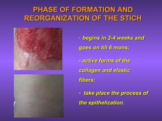 PHASE OF FORMATION ANDPHASE OF FORMATION AND
REORGANIZATION OF THE STICHREORGANIZATION OF THE STICH
- begins in 2-4 weeks andbegins in 2-4 weeks and
goes on till 6 mons;goes on till 6 mons;
- active forms of theactive forms of the
collagen and elasticcollagen and elastic
fibers;fibers;
- take place the process oftake place the process of
the epithelization.the epithelization.
 