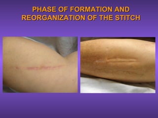 PHASE OF FORMATION ANDPHASE OF FORMATION AND
REORGANIZATION OF THE STITCHREORGANIZATION OF THE STITCH
 