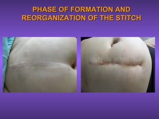 PHASE OF FORMATION ANDPHASE OF FORMATION AND
REORGANIZATION OF THE STITCHREORGANIZATION OF THE STITCH
 