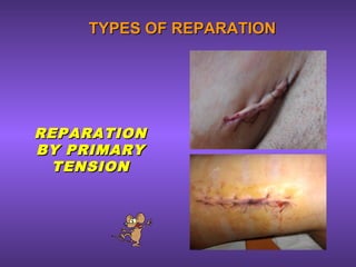 TYPES OF REPARATIONTYPES OF REPARATION
REPARATIONREPARATION
BY PRIMARYBY PRIMARY
TENSIONTENSION
 