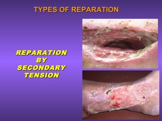 TYPES OF REPARATIONTYPES OF REPARATION
REPARATIONREPARATION
BYBY
SECONDARYSECONDARY
TENSIONTENSION
 