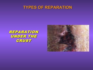 TYPES OF REPARATIONTYPES OF REPARATION
REPARATIONREPARATION
UNDER THEUNDER THE
CRUSTCRUST
 