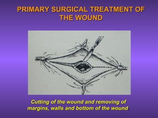 PRIMARY SURGICAL TREATMENT OFPRIMARY SURGICAL TREATMENT OF
THE WOUNDTHE WOUND
Cutting of the wound and removing ofCutting of the wound and removing of
margins, walls and bottom of the woundmargins, walls and bottom of the wound..
 